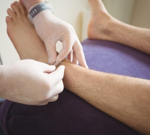 imgi_48_physiotherapist-performing-dry-needling-leg-patient_107420-65804