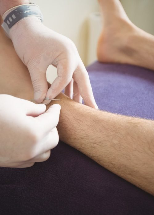 imgi_48_physiotherapist-performing-dry-needling-leg-patient_107420-65804